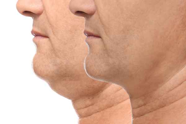 HIFU - Breakthrough in Anti - ageing 2 hifu results Cambridgeshire