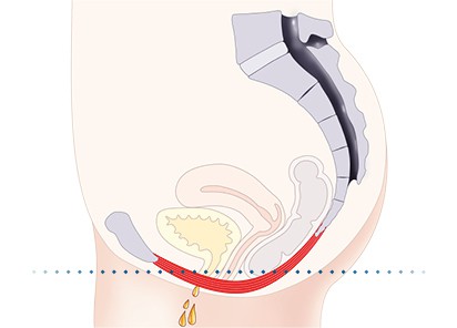 Pelvic-Floor Muscle Repair 5 Pelvic floor muscles Cambridgeshire