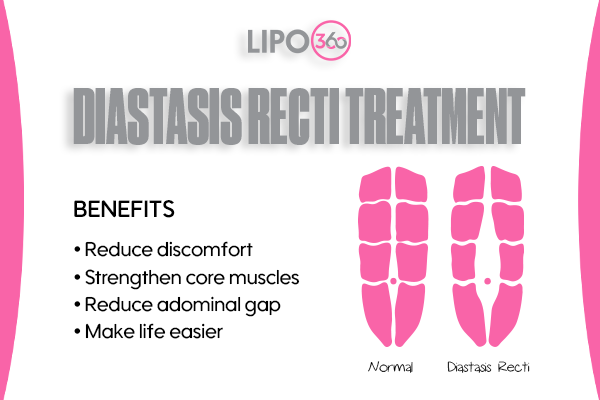 Revolutionising Muscle Repair: The Power of LIPO360 Body Sculpt Post-Injury 5 diastasis recti treatment Cambridgeshire