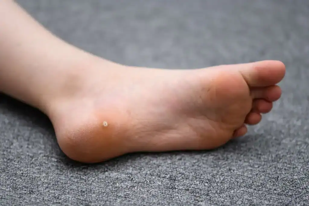 Cryotherapy For Warts And Also Verrucas 2 Image of verruca on the bottom of the foot that able to be treated with Cryotherapy Cambridgeshire